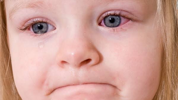التهابات العين عند الأطفال