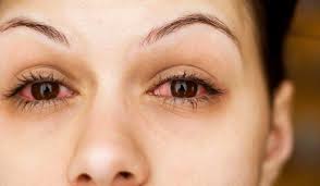 التهابات الحساسية في العين