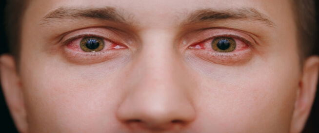 أعراض التهابات العين